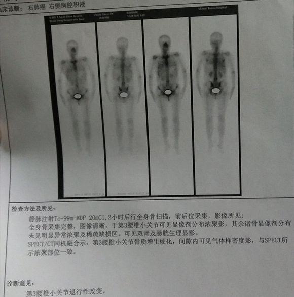 不管中医还是西医给我看看现在吃的国产靶向药吉非替尼