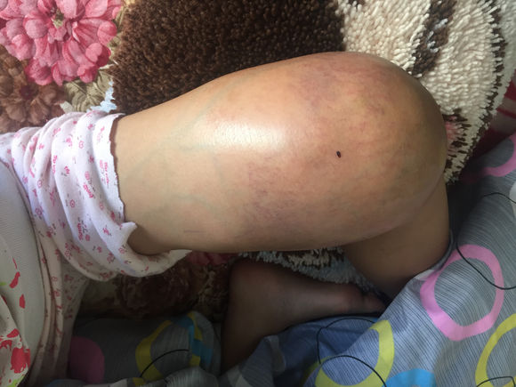 女儿14岁，明天做截肢手术。医生让从髋关节处截