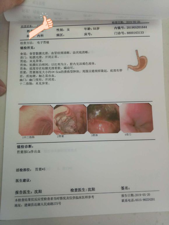 妈妈才55周岁这几天被确诊为胃印戒细胞癌