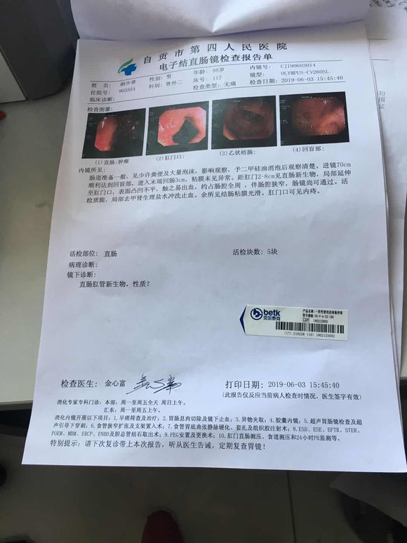 我家公90岁了，上厕所难，去医院检查出来是直肠癌！！