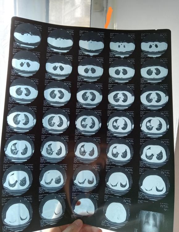 医生说姥姥可能是肺癌麻烦大家帮忙看一下万分感谢