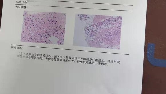 大细胞肺癌，患者70岁，有常年吸烟氏